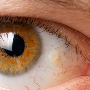 Pinguecula of the eye