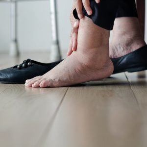 Close-up of someone's feet; they are sitting down, and have removed one shoe. Their ankles seem to be pretty swollen